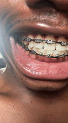 Person shows off dental braces in Nigeria photos