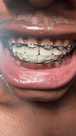Person shows off dental braces in Nigeria photos