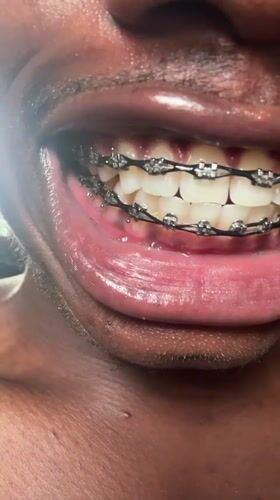 Person shows off dental braces in Nigeria photos