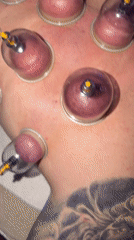 Person undergoes cupping therapy treatment with multiple cups applied