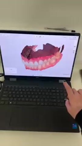 Here's a description of the video:

The video shows a person's hand interacting with a laptop screen displaying a 3D model of a set of teeth and gums. The person uses their finger to rotate the model on the screen, showing different angles of the teeth and gum structure. The laptop is a black Dell model. The person is wearing a black long-sleeved shirt. The background is a plain white surface.