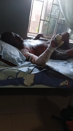 Burned individual observed recovering in bedroom bed