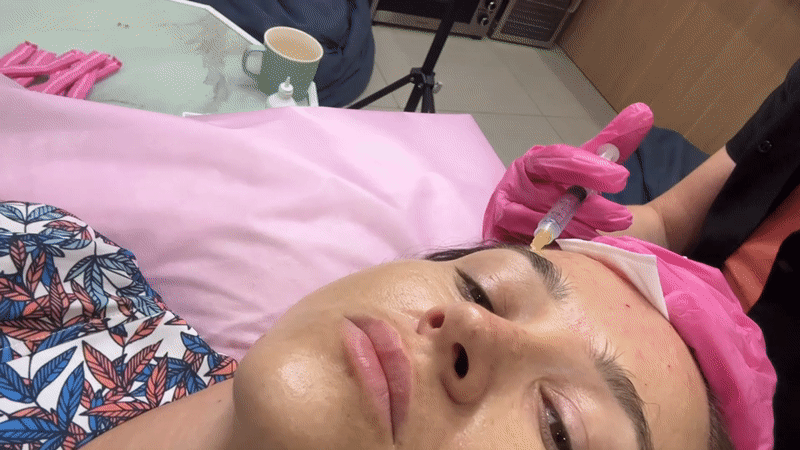 Cosmetic injection procedure at a Nha Trang clinic