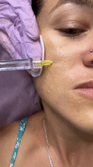 Woman receives facial injections, skincare treatment in Nha Trang