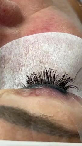 A close-up shot shows an individual's eye with eyelash extensions being applied. The subject's eye is partially covered by a white protective patch. Tweezers are delicately placing individual extensions onto the natural lashes. The surrounding skin appears slightly red, possibly from the application process or as a natural coloration. The lighting is bright and focused on the eye area, highlighting the intricate work being done.