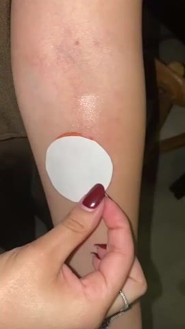 A close-up shot shows a person's arm with a visible bruise and what appears to be a prosthetic or fake wound. The wound is circular, reddish, and looks like a burn or raw skin. The person is holding a white circular paper disk or patch over the wound. The person's fingers, adorned with dark red nail polish and a ring on one finger, are visible. The skin tone is fair. Part of a brown garment can be seen on the left of the frame, and a portion of a wooden object, possibly furniture, is visible in the background on the right.