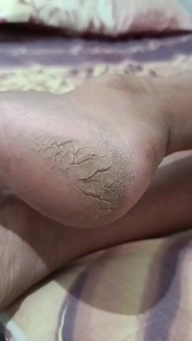 The video shows a close-up of a person's cracked heel. The skin is dry and flaky, with deep fissures visible. The heel is resting on a surface covered with a patterned fabric, likely a bedspread. The lighting appears to be artificial and somewhat dim.