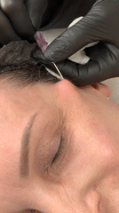 Cosmetic procedure documented in Chaikovsky, Russia