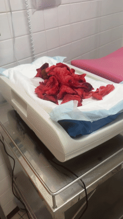 Medical procedure aftermath documented in Tourcoing, France