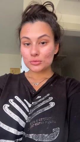 A woman wearing a dark t-shirt with a white skeletal design stands in front of the camera, looking directly at it. A man in a white shirt kisses her right cheek, and a young child's face is partially visible behind the man, peeking over his shoulder. The woman has dark hair tied up, and her skin shows signs of acne or blemishes, particularly on her cheeks and chin. She is wearing a delicate necklace. The background is a light-colored wall.