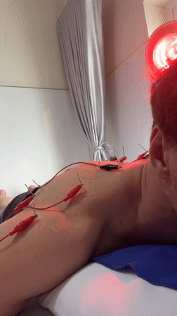 Person receives electroacupuncture treatment in Nha Trang, Vietnam