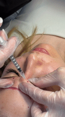 Cosmetic filler procedure documented at Chaikovsky clinic