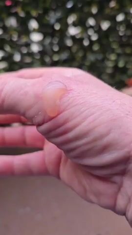 A close-up video shows a blister on a person's hand. The blister appears to be filled with clear fluid and is surrounded by reddened skin. The background is out of focus and appears to be an outdoor setting with greenery and a brown surface.