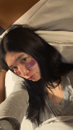 Woman documents skincare routine with eye patches in Essen