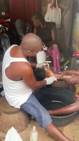 A man wearing a white tank top and blue pants, with white gloves on his hands, is tending to a person's leg which is in a black basin filled with water. The man is holding the leg and appears to be cleaning or treating a wound. The wound on the leg is visible and appears to be severe, with exposed tissue and some stringy material hanging from it. Another woman, wearing a black top and pink patterned pants, is seated behind the man and is holding a white plastic bag, possibly containing medical supplies. Her hands are also gloved. The environment appears to be outdoors or in a rustic setting, with a dirt floor and rudimentary structures visible in the background. There are various objects scattered around, including bags, bottles, and what look like medical supplies. The lighting suggests it is daytime. The overall scene depicts a medical treatment being administered in a non-clinical setting.