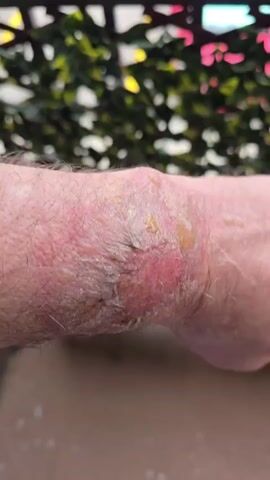 The video shows a close-up view of a person's left wrist and the back of their hand, focusing on a skin condition. The skin appears red, inflamed, and dry with some peeling. There are also several blisters visible, some filled with clear fluid and others that appear to be broken. The background is blurred but suggests an outdoor setting with green foliage and possibly some colorful flowers. The lighting is bright, indicating daytime. The camera slowly pans across the affected area, providing a detailed view of the skin's texture and the blisters.