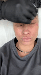 Facial injection treatment documented at Perm clinic