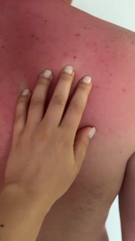 Here's a description of the video:

The video shows the back of a person, highly sunburned with reddened skin. A hand, presumably belonging to another person, is placed on the sunburned back, pressing down on the skin and briefly leaving a white indentation where it had been. The background is a plain white wall.
