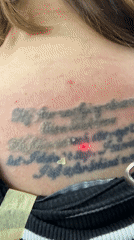 Tattoo removal procedure documented in Sofia by witnesses