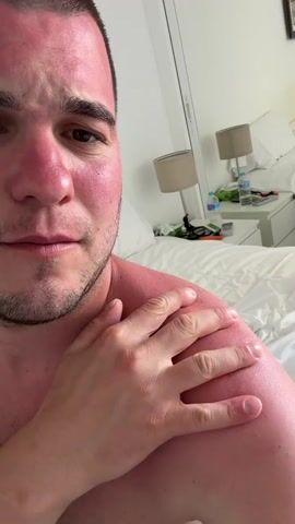 A fair-skinned man with short dark hair and a stubbly beard is holding the camera in front of his face, looking into the lens. He is topless, revealing red sunburn on his face and left shoulder. He runs his right hand over his shoulder, which is also red and glossy. His expression changes from a slightly concerned frown to a small smile. Behind him, there's a white bed with a white duvet, and a white bedside table with two lamps and a water bottle. The room appears bright and clean.