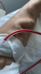 Close-up look at a dialysis session in progress