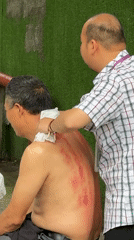 Outdoor back treatment session observed in Yuzhong District