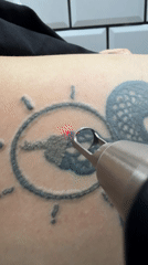 Tattoo removal sessions and spring blooms documented in Sofia