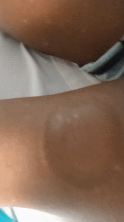 Cupping therapy session documented in Nigerian suburbs