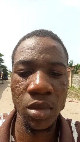 A close-up shot shows a man's face, his head tilted downwards. His skin appears oily and shows signs of acne scarring, particularly on the cheeks. He has short dark hair and stubble. He wears a brown and white striped shirt. The background includes a dirt road, a car parked on the side of the road, and a concrete block wall with sparse vegetation. A woman in a blue shirt and patterned skirt walks along the road behind him. The sky is bright and overcast.
