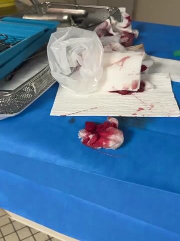 The video shows a table covered with a blue sheet, possibly in a medical setting. The table contains bloody gauze pads and paper towels, a clear plastic bag, and a metal tray. The tray contains various surgical instruments, including clamps, scissors, and retractors. The items suggest a recent medical procedure or operation.
