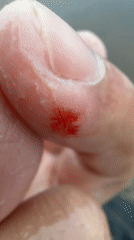 Man documents finger cut, takes selfies in foggy Chaikovsky