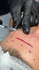 Medical injection administered to patient's forehead during procedure