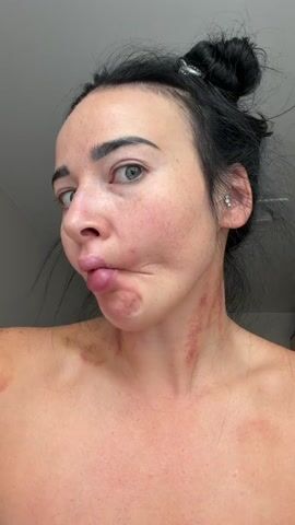 A woman with dark hair pulled up in a bun makes a fish face. She has red marks on her neck and shoulders and is wearing no shirt. The video is a close-up of her face and upper body.