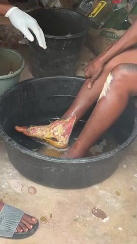 A video captures an individual's lower legs and feet submerged in a large black basin filled with murky water. The individual's right leg exhibits a severe open wound extending from the shin to the foot, characterized by exposed tissue and a yellowish discharge. A person wearing white gloves is seen attending to the wound, holding a small black object. The environment appears to be outdoors or in a poorly maintained indoor space, with dirt or concrete flooring and a backdrop of various objects, including plastic containers and what looks like a poster. Another person's bare feet wearing sandals are visible in the foreground. The scene suggests a medical or hygiene-related intervention for a serious injury.