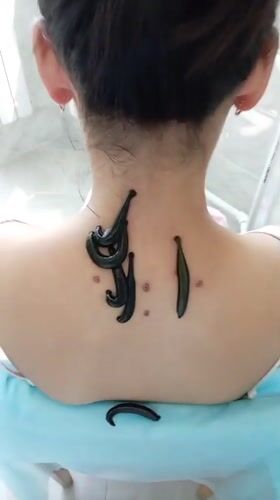 Leech therapy in progress on neck and upper back