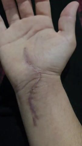 The video shows a close-up of a person's left wrist and palm. A prominent scar runs across the wrist and extends partially into the palm. Small, dark dots are visible along the scar line. The background is dark and out of focus, with a glimpse of what appears to be a patterned fabric.