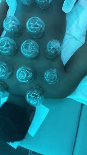 Traditional cupping therapy session observed in Yuzhong District