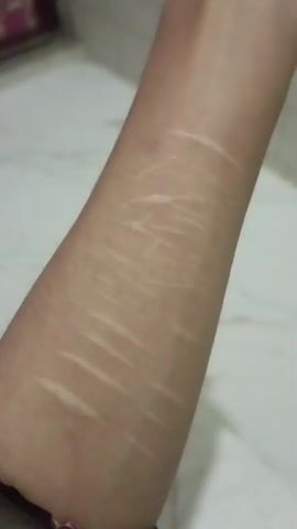 A close-up shot shows an arm covered in scars, likely from self-harm. The scars vary in age and depth, with some appearing raised and lighter in color, indicating older wounds, while others are more recent. The arm is positioned against a light-colored, tiled surface, possibly a wall or floor, out of focus in the background.