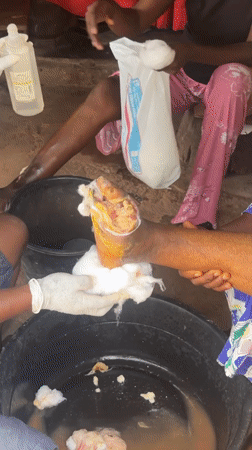 Wound care treatment for infected foot in Enugu, Nigeria