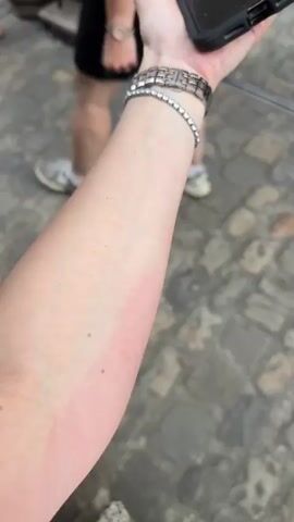 The video shows a close-up of a person's arm with visible redness and some lighter pink areas, suggesting irritation or a rash. The arm is held up, and the camera is focused on the skin. In the background, out of focus, other people are visible walking on a cobblestone surface. One person is wearing light-colored pants and white sneakers. Another person is wearing shorts and sneakers. A third person is wearing a skirt or dress and sandals. The overall environment appears to be an outdoor setting, likely a street or plaza. The person holding the arm is also holding a phone. The redness on the arm appears to be concentrated in a band-like pattern.